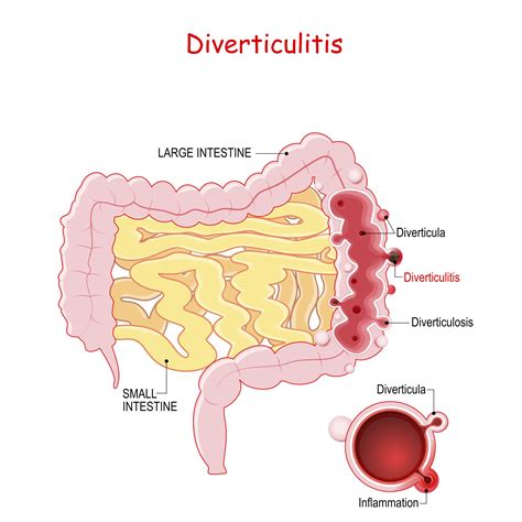 diverticulitis diagram